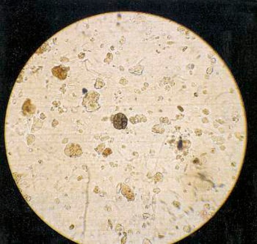 Δείγμα αφρικανικής σκόνης που συλλέχτηκε στα νησιά Μπαρμπάντος, μεταφέρει μη αναγνωρισμένο μύκητα (στο κέντρο της φωτογραφίας). Πάνω από 100 είδη βακτηρίων, ιών και μυκήτων υπάρχουν στη σκόνη. Περίπου το ένα τρίτο των βακτηρίων είναι παθογόνα και μπορούν να προκαλέσουν ασθένειες σε φυτά, ζώα, αλλά και στον άνθρωπο. Ανάμεσά τους είναι οι ψευδομονάδες, που προκαλούν μολύνσεις των αυτιών και του δέρματος