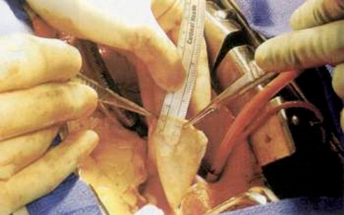 Το τοίχωμα της αορτής στην περιοχή του ανευρύσματος έχει γίνει τόσο λεπτό, που είναι ημιδιάφανο. Νέα ευρήματα ενοχοποιούν μια κατηγορία ενζύμων, τις μεταλλοπρωτεϊνάσες, που όταν είναι υπερδραστήριες κατατρώνε τις πρωτεΐνες, που δίνουν ελαστικότητα στα αρτηριακά τοιχώματα