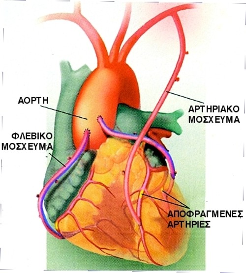 Συνήθως η εγχείρηση μπαϊπάς απαιτεί την τοποθέτηση τριών έως πέντε μοσχευμάτων στις υπάρχουσες αρτηρίες, έτσι ώστε το αίμα να ρέει μέσα από τις παρακάμψεις αντί μέσα από τα φραγμένα αγγεία. Οι γιατροί χρησιμοποιούν είτε κομμάτια αρτηριών από την περιοχή γύρω από την καρδιά, είτε κομμάτια φλεβών από τα πόδια.