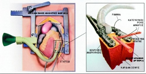 Ο σταθεροποιητής που ονομάζεται «χταπόδι», ακινητοποιεί μια περιοχή στην επιφάνειας της καρδιάς που χτυπά, ώστε οι χειρουργοί να μπορέσουν να ράψουν τα μοσχεύματα μπαϊπάς. Για να το πετύχει χρησιμοποιεί αναρρόφηση. Αν και η καρδιά συνεχίζει να χτυπά, το τμήμα που ενδιαφέρει παραμένει σχεδόν ακίνητο