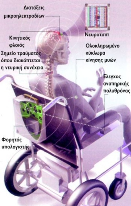 Στην απώτερη χρήση της νευροπροσθετικής τα σήματα από τα εμφυτευμένα μικροηλεκτρόδια μεταδίδονται ασύρματα στον υπολογιστή που βρίσκεται στην πλάτη της αναπηρικής πολυθρόνας. Ο Η/Υ ερμηνεύει τα σήματα αυτά που δημιουργήθηκαν από τη σκέψη της κίνησης του χεριού και μεταδίδει επίσης ασύρματα την εντολή σε τσιπ εμφυτευμένο στο χέρι, το οποίο ερεθίζει κατάλληλα τους μύες. Εναλλακτικά, στέλνει απευθείας εντολή κίνησης στην πολυθρόνα ή ένα ρομποτικό βραχίονα, αν ο παράλυτος έχει χάσει και το χέρι του