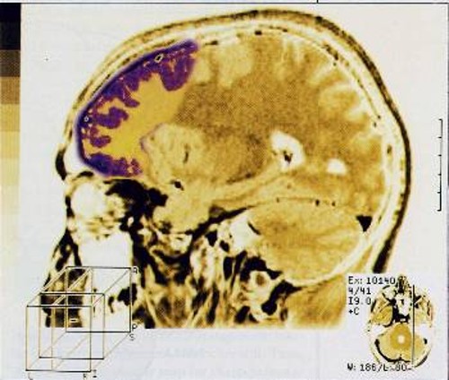 Η συναισθηματική δραστηριότητα στον εγκέφαλο εντοπίζεται στον μετωπιαίο λοβό, όπως φαίνεται σε αυτή τη χρωματισμένη εικόνα από τομογράφο μαγνητικού πυρηνικού συντονισμού (MRI)