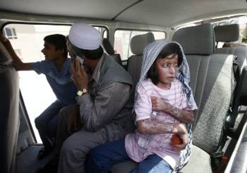 Κοριτσάκι στο Αφγανιστάν καμένο από βόμβα φωσφόρου των ΗΠΑ