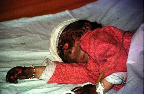 Εκατομμύρια είναι τα παιδιά - θύματα των πολέμων. Στη φωτογραφία, κοριτσάκι με εγκαύματα από τους ΝΑΤΟικούς βομβαρδισμούς στη Γιουγκοσλαβία