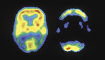 Απεικονίσεις PET του εγκεφάλου ενός υγιούς (αριστερά) και ενός ασθενούς με Αλτσχάιμερ (δεξιά)